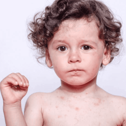 Homeopathy for Skin