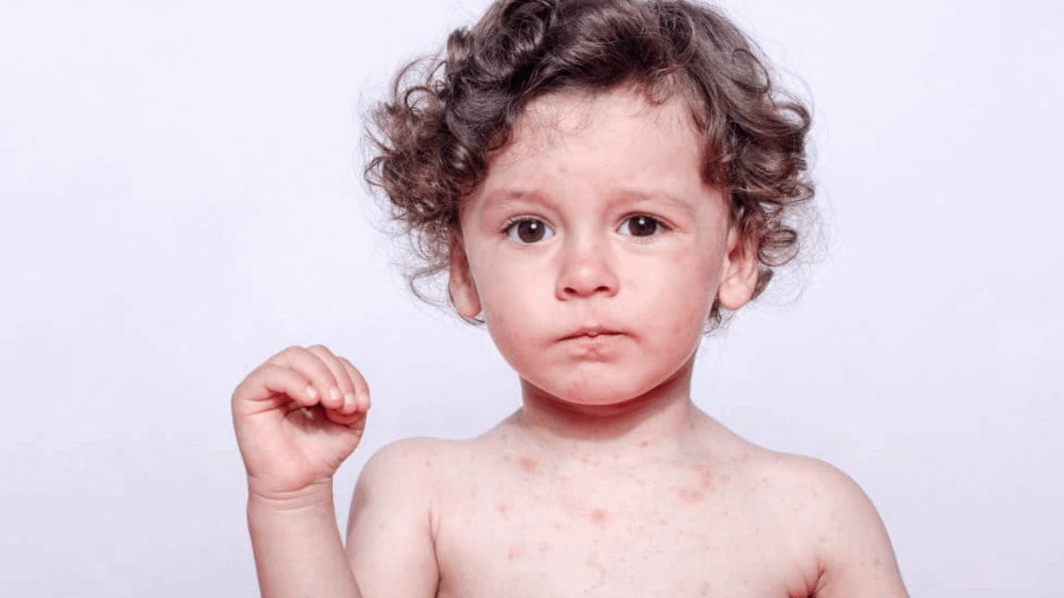 Homeopathy for Skin