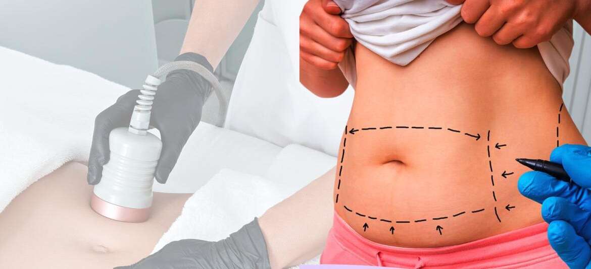 U-lipolysis