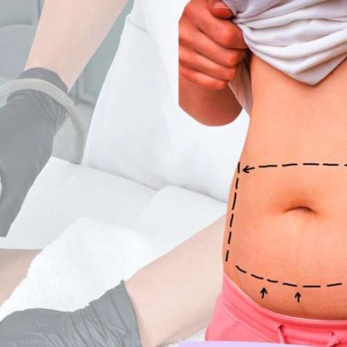 U-lipolysis